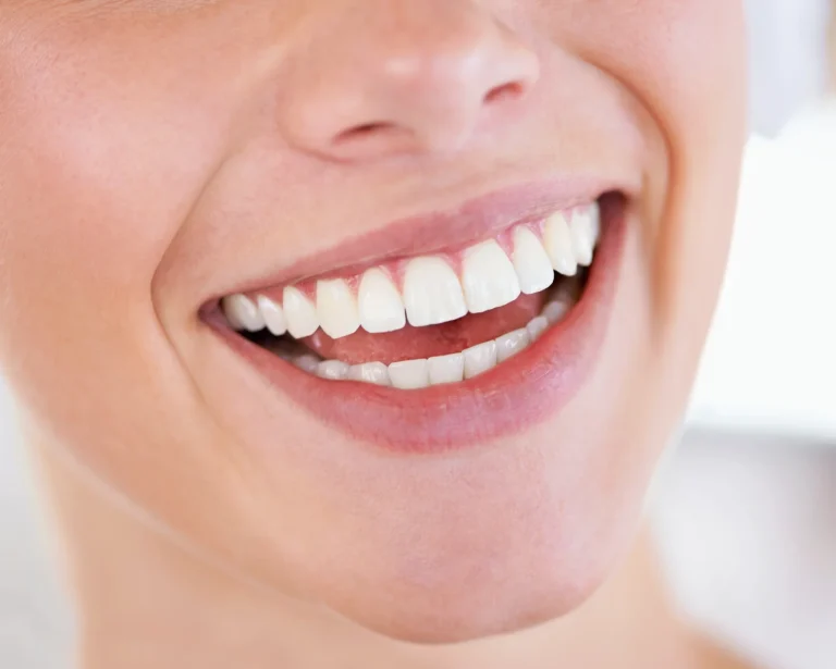 Cosmetic teeth whitening result