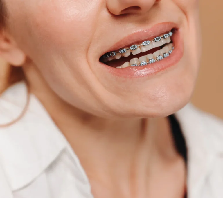 Orthodontic braces closeup view