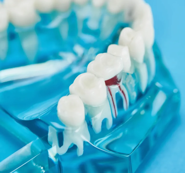 Dental filling tooth model