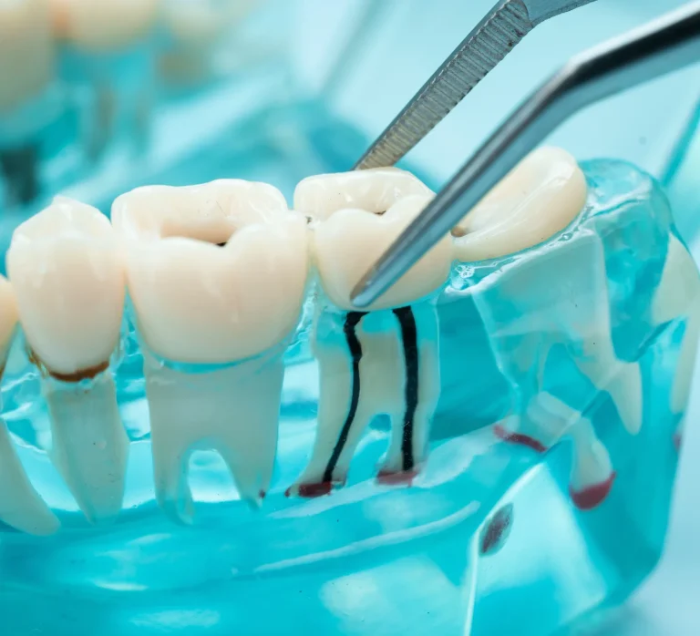 Root canal dental procedure