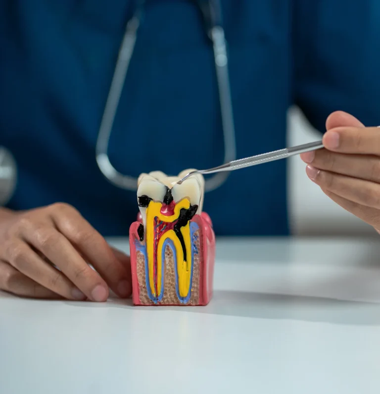Root canal treatment
