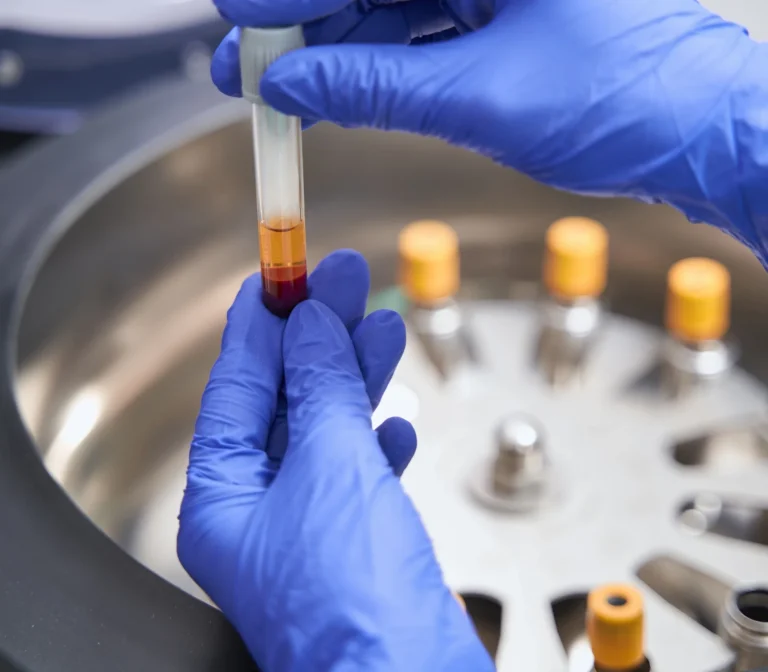 PRF treatment preparation tubes